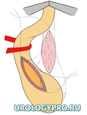 Этапы трансплантации слизистой щеки в уретру